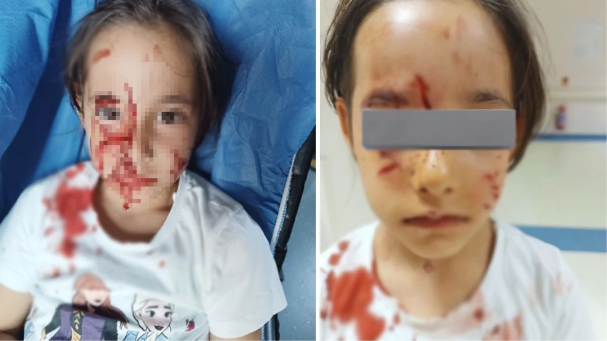 İstanbul’da başıboş sokak köpeği, 6 yaşındaki kız çocuğunu kanlar içerisinde bıraktı