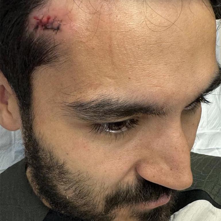 Barcelonanın yıldızı İlkay Gündoğandan korkutan kaza: 4 dikiş atıldı