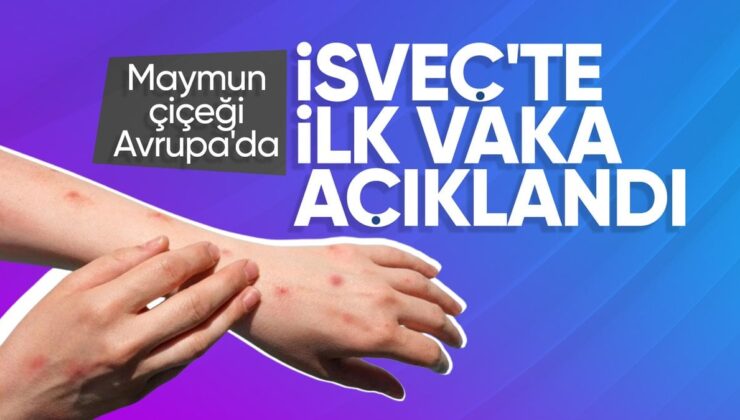 Maymun çiçeği virüsü İsveç’te görüldü