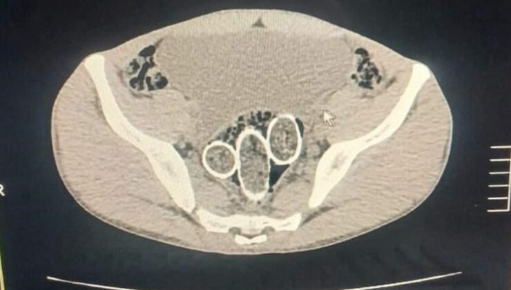 Denizli’de şüphelilerin midesinden ve rahminden uyuşturucu çıktı
