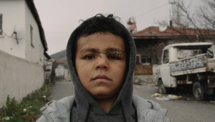 Adana’da başıboş köpekler 5 yaşındaki çocuğa saldırdı