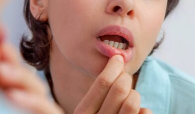 Ağız içerisinde çıkan ve geçmeyen yaralar, kansere davetiye çıkarıyor