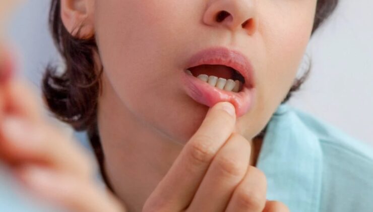 Ağız içerisinde çıkan ve geçmeyen yaralar, kansere davetiye çıkarıyor