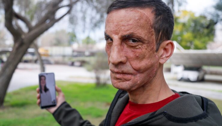 Türkiye’de ilk yüz nakli yapılan Uğur Acar’dan duygusal görüşme