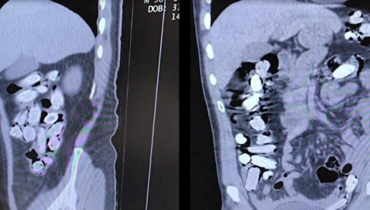 Bitlis’te uyuşturucu operasyonu: Mide ve bağırsaklarından 1 kilo çıktı