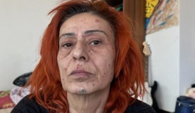 Boya yüzünden yüzü yanmıştı! Yıldız Tilbe’den yeni açıklama geldi