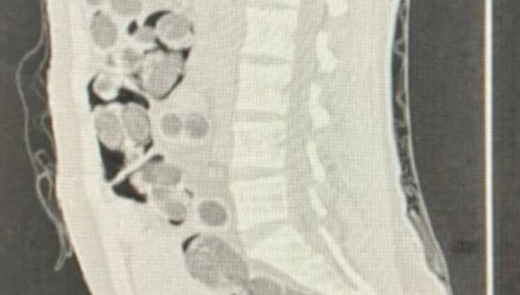 Denizli’de yabancı uyruklu yolcunun midesinden 219 paket uyuşturucu çıktı