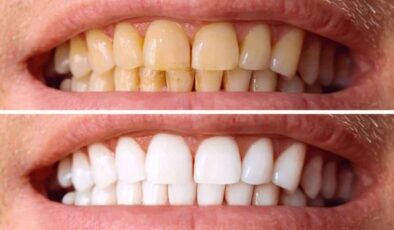 Diş taşı temizliğinde bilinmesi gerekenler: Enfeksiyona neden olur mu