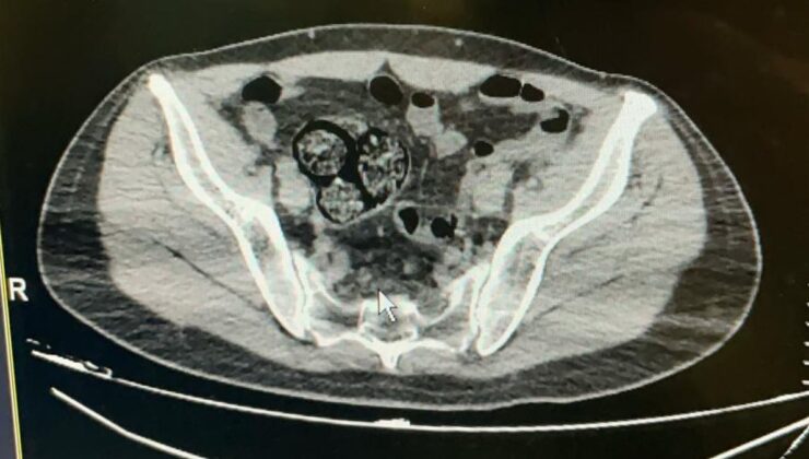 Artvin’de İranlı şüphelinin bağırsaklarından uyuşturucu çıktı