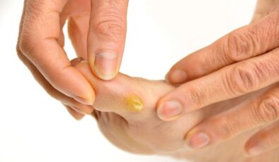 Nasır nedir, nasıl önlenir, kanserle ilişkisi var mı