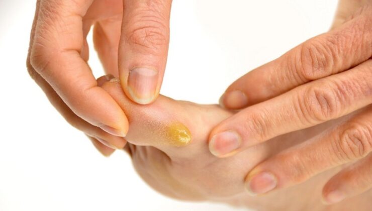 Nasır nedir, nasıl önlenir, kanserle ilişkisi var mı