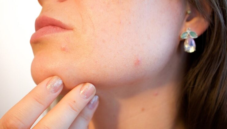 Sivilce sıkmanın sakıncaları