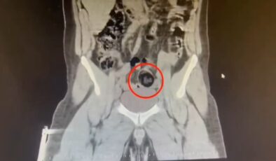 Kars’ta İranlı yolcu makatında uyuşturucuyla yakalandı