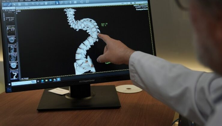 Skolyoz hastalığında erken teşhisin önemi