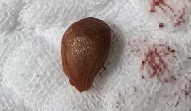 Trabzon’da karayemiş çekirdeği yüzünden akciğer ameliyatı geçirdi