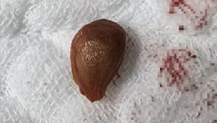 Trabzon’da karayemiş çekirdeği yüzünden akciğer ameliyatı geçirdi