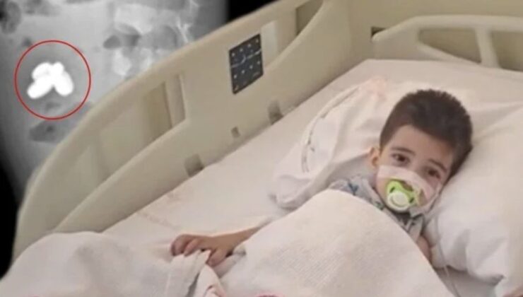 İstanbul’da pil ve mıknatıs yutan çocuğun bağırsakları yandı