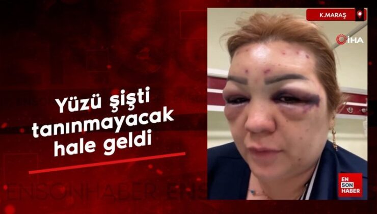 Kahramanmaraş’ta botoks sonrası yüzü şişti tanınmayacak hale geldi