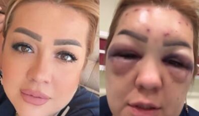 Kahramanmaraş’ta botoks yaptıran kadının yüzü tanınmayacak hale geldi