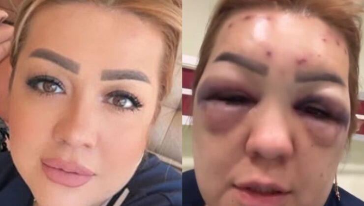 Kahramanmaraş’ta botoks yaptıran kadının yüzü tanınmayacak hale geldi