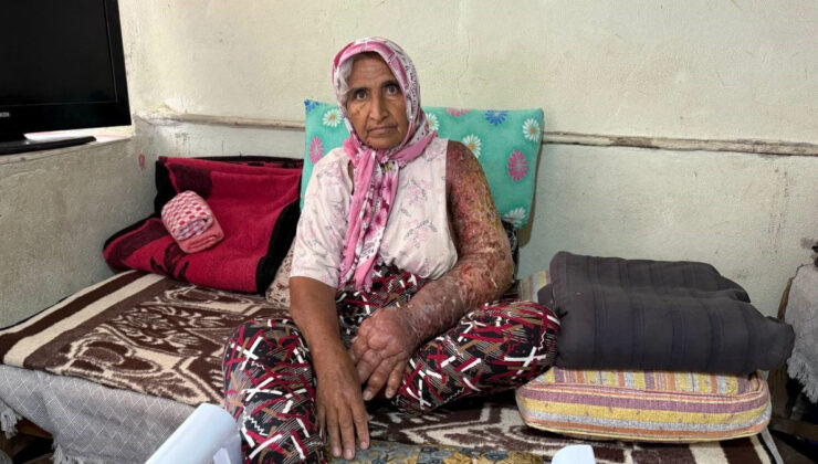 Adana’da kolları şişen bayanın kaygısına deva bulunamıyor