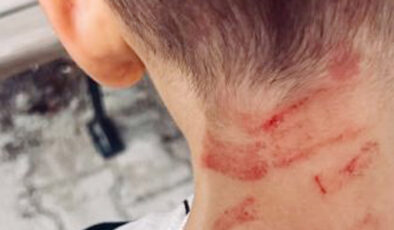 Burdur’da özel ihtiyaçlı çocuğa darp: Soruşturma açıldı