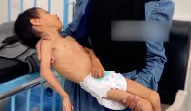 Gazze’de bir çocuk daha yetersiz beslenme nedeniyle ömür savaşı veriyor