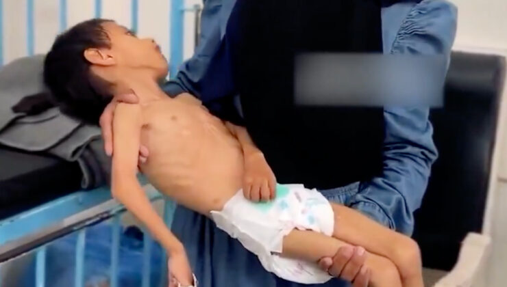 Gazze’de bir çocuk daha yetersiz beslenme nedeniyle ömür savaşı veriyor