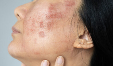 Lupus hastalığı hakkında bilmeniz gerekenler