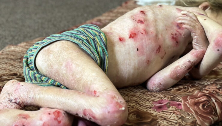 Gazze’de çocuklar hem açlık hem de hastalıkla çaba ediyor