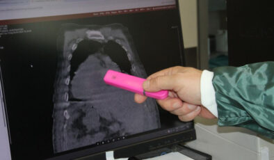 Giresun’dan tıp dünyasına katkı: Karadeniz Sendromu