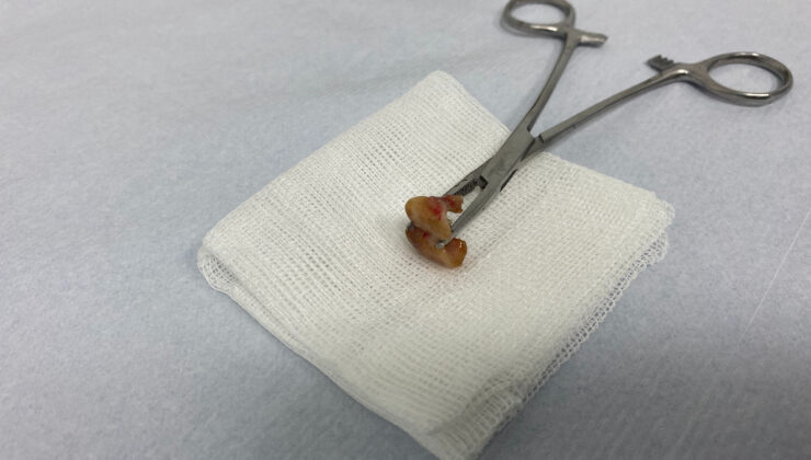 İstanbul’da uykusunda iki dişini yuttu, soluğu hastanede aldı