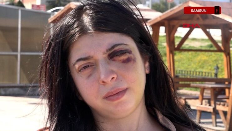 Samsun’da darbedilen Damla: Platinler daima yüzümde kalacakmış