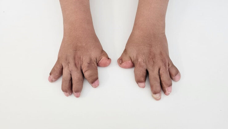 Tabiplerin ismini yeni duyduğu rahatsızlıkla doğan Umut’un 10 parmağı ameliyatla açıldı