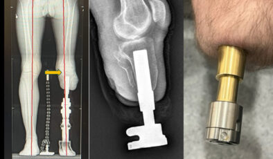 Protez kullananlara umut olan osseointegrasyon formülü