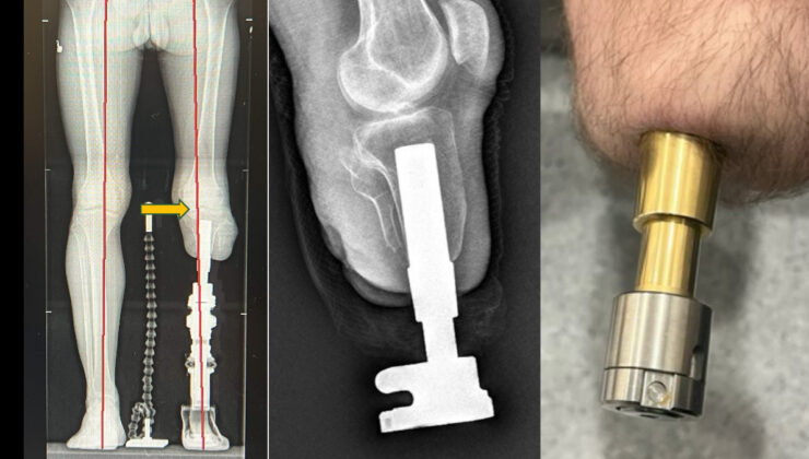 Protez kullananlara umut olan osseointegrasyon formülü