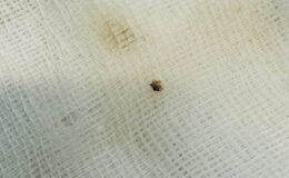 Kahramanmaraş’ta halsizlik nedeniyle hastaneye gitti: Karnına yapışan kene bulundu