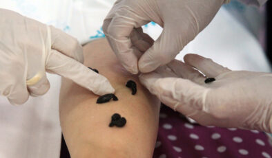 Sülük tedavisi caiz midir? Diyanet yanıtladı: Sülükle tedavinin kararı…