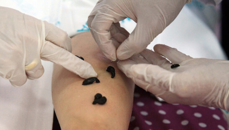 Sülük tedavisi caiz midir? Diyanet yanıtladı: Sülükle tedavinin kararı…