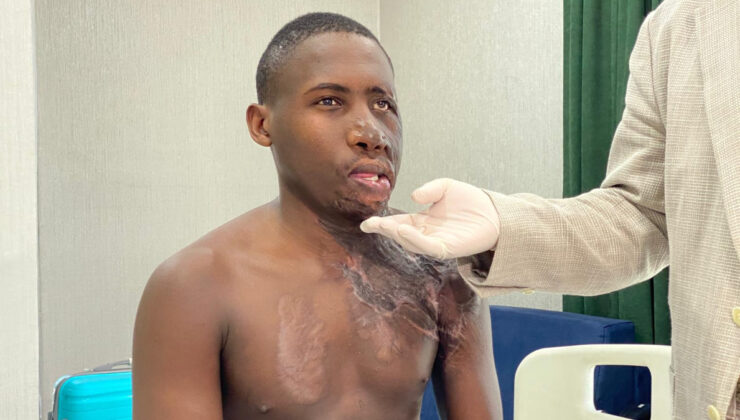 Yüzü yanan Ugandalı çoban, Ankara’da sıhhatine kavuştu