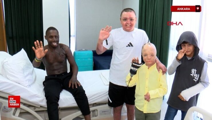 Yüzü yanan Ugandalı çoban Ankara’da tedavi edildi