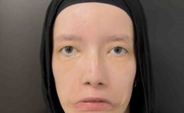 23 Yılı Mimiksiz Geçirdi: Türk Tabiplerin Operasyonuyla Birinci Kere Gülümsedi