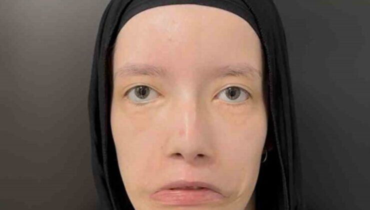 23 Yılı Mimiksiz Geçirdi: Türk Tabiplerin Operasyonuyla Birinci Kere Gülümsedi