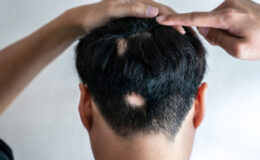 Ağır gerilim erkeklerde saçkırana neden oluyor