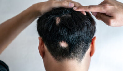 Ağır gerilim erkeklerde saçkırana neden oluyor