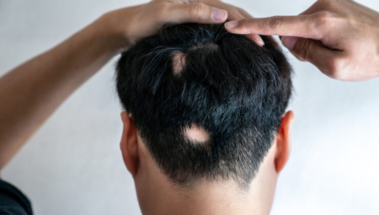 Ağır gerilim erkeklerde saçkırana neden oluyor