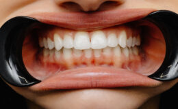Diş etlerindeki renk değişiklikleri hastalıkların habercisi olabilir