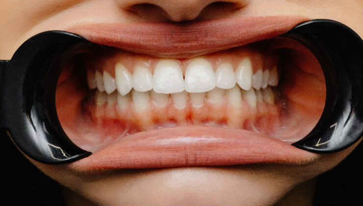 Diş etlerindeki renk değişiklikleri hastalıkların habercisi olabilir