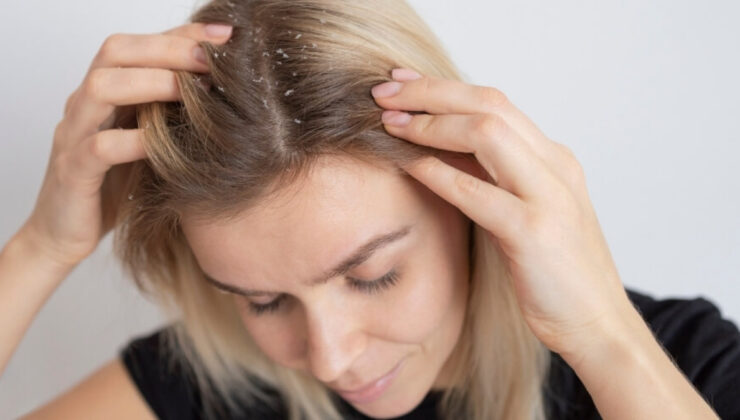 Saçta egzama neden olur? Saç egzamasına ne düzgün gelir?