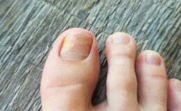 Tırnak mantarına doğal tahlil: 2 materyal yetiyor, mantardan eser kalmıyor